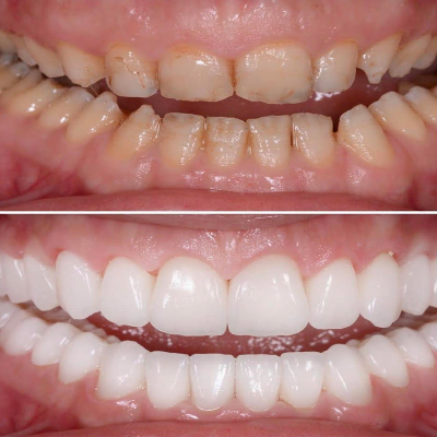 Full Mouth Rehabilitation