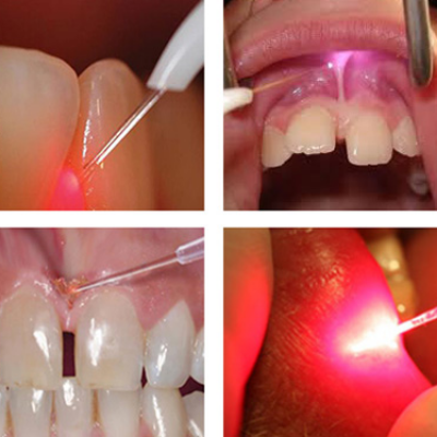  Electro Cautery Dental Laser
